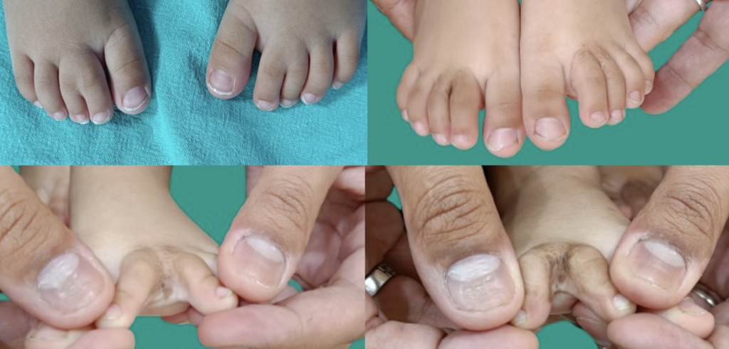 Toe syndactyly release